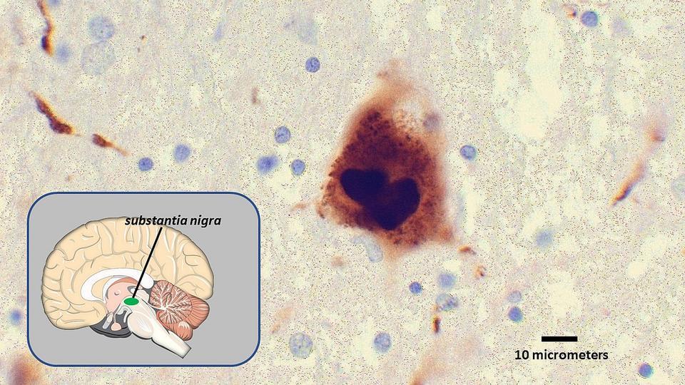 A protein clump called a Lewy body (center), along with a map (inset) of where in the brain the scan was taken