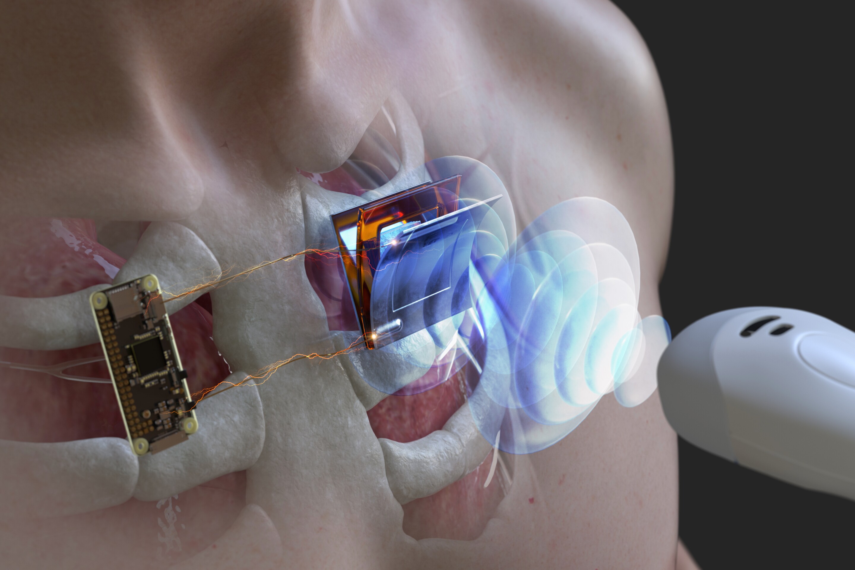 Implanted generator could use ultrasound to charge pacemaker batteries