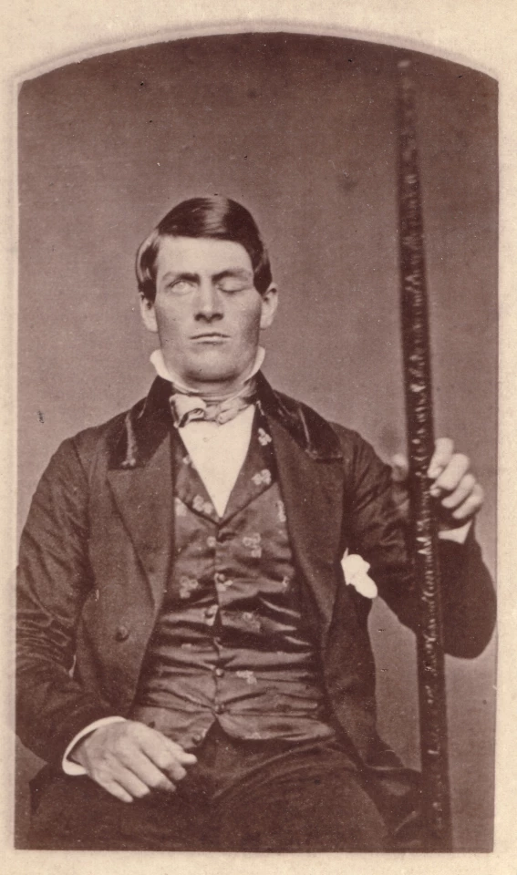 Phineas Gage posing with the tamping iron that shot through his head as the result of a premature explosion while blasting