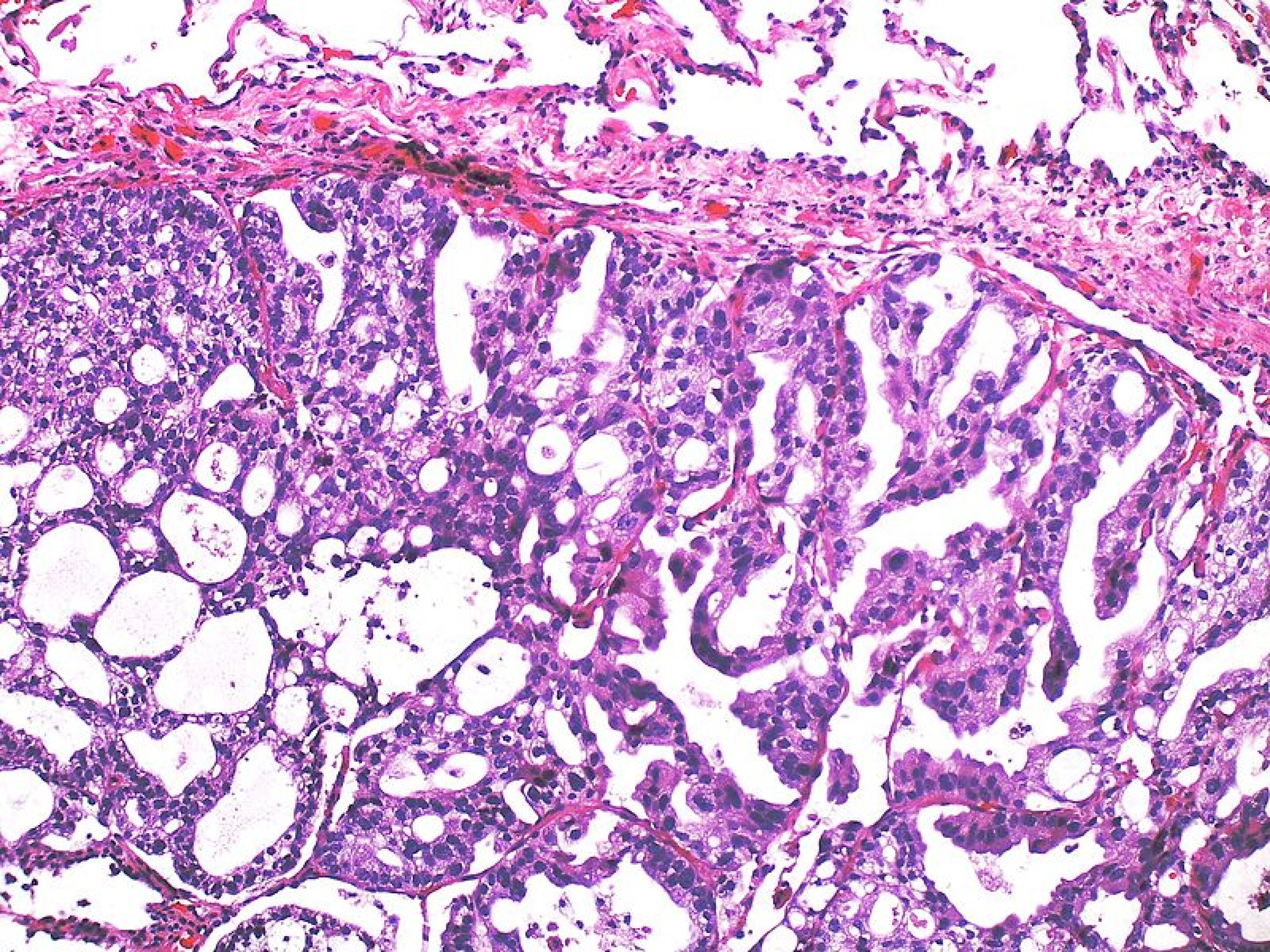 Light reflectance fine tunes prostate cancer surgery