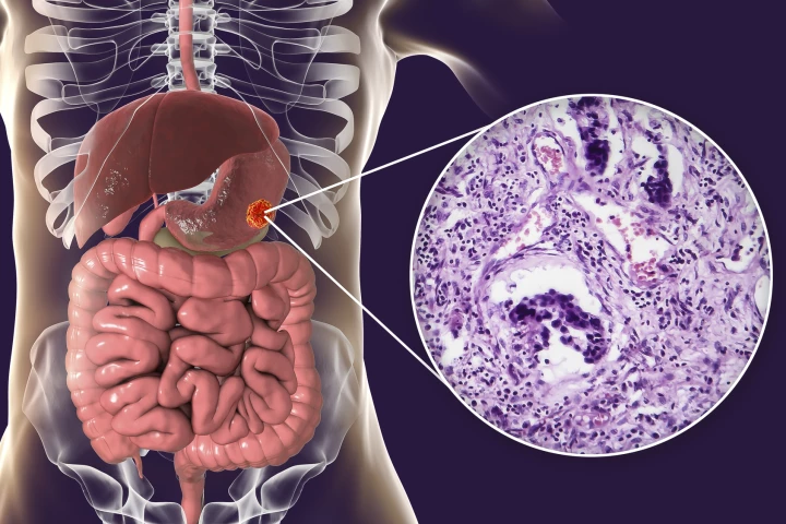 Researchers have identified a biomarker that can accurately diagnose gastric cancer
