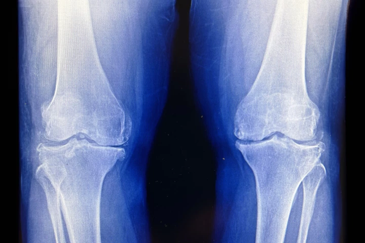 Low-dose radiation treatment may delay knee replacement surgery in people with osteoarthritis