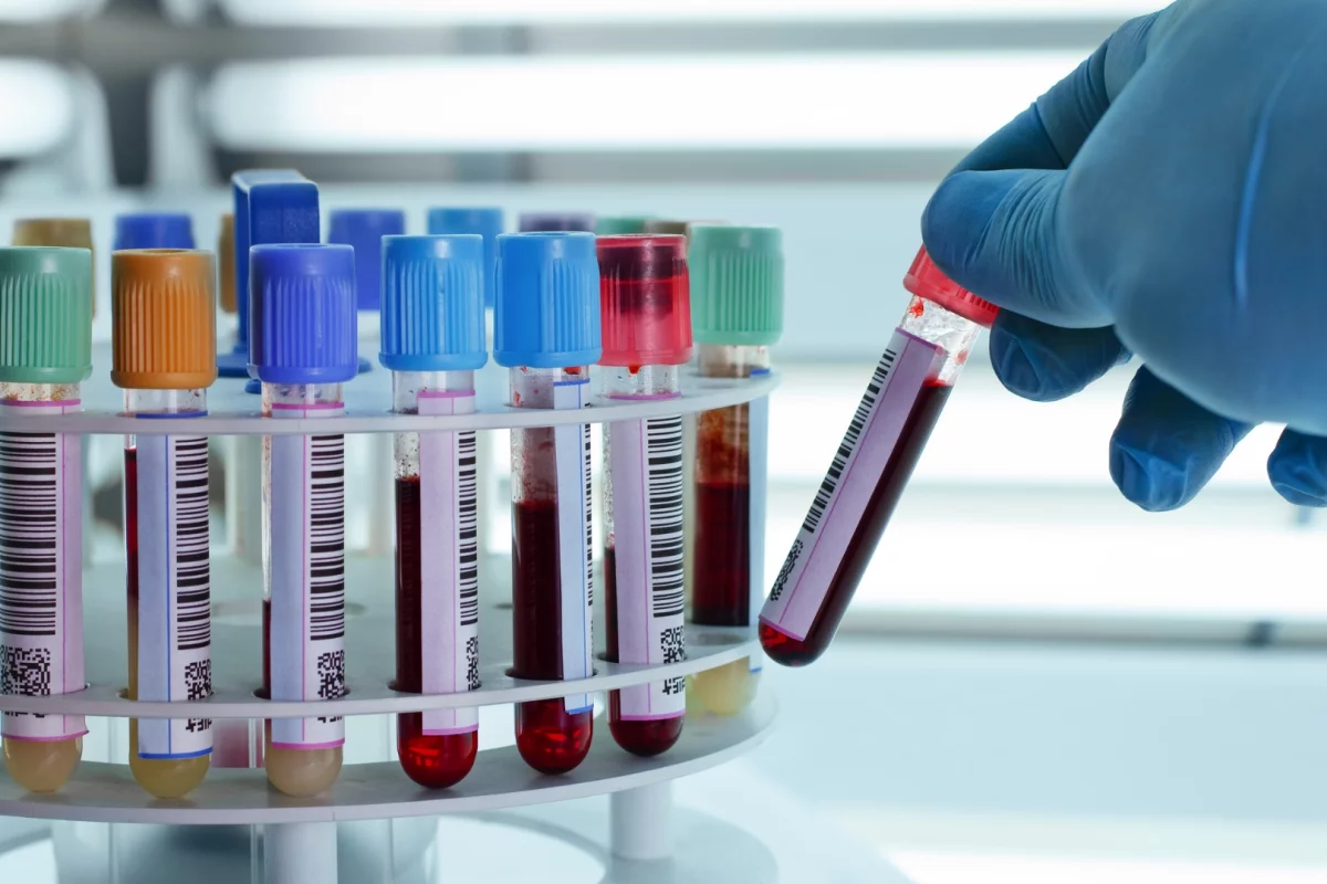 A new study suggesting a path to a blood and urine test for autism has been greeted with skepticism from researchers in the field