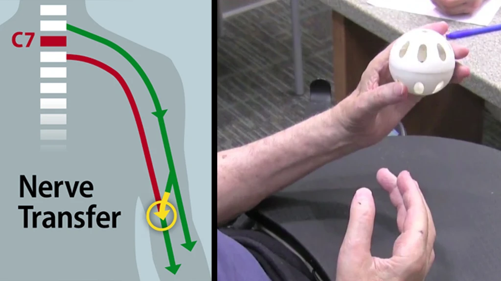 Surgeons have restored some hand function to a quadriplegic patient by rerouting nerves in the patient’s upper arm to bypass the block at their C7 spinal cord injury