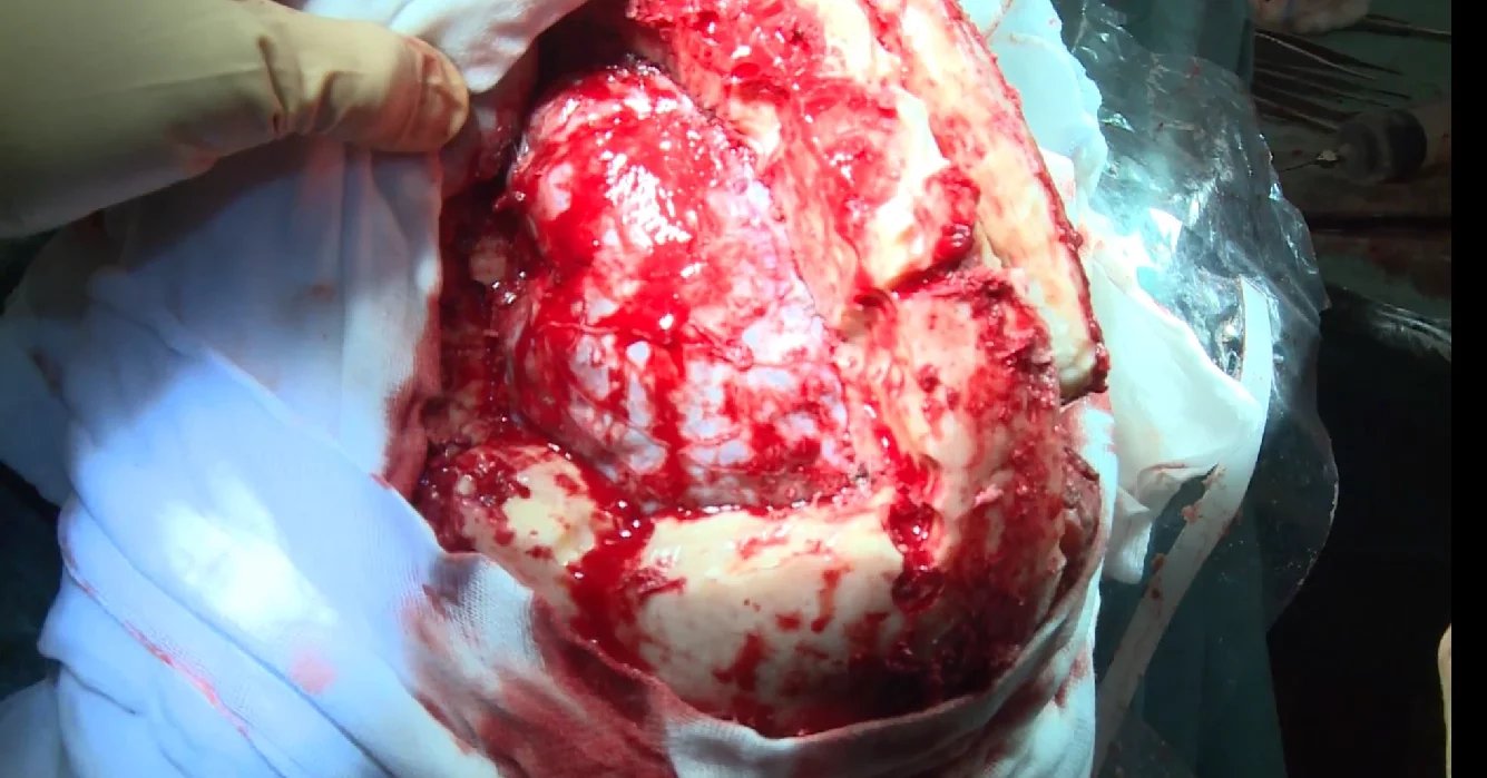 The top portion of the woman's skull was removed due to a thickening condition that resulted in loss of vision and motor impairment