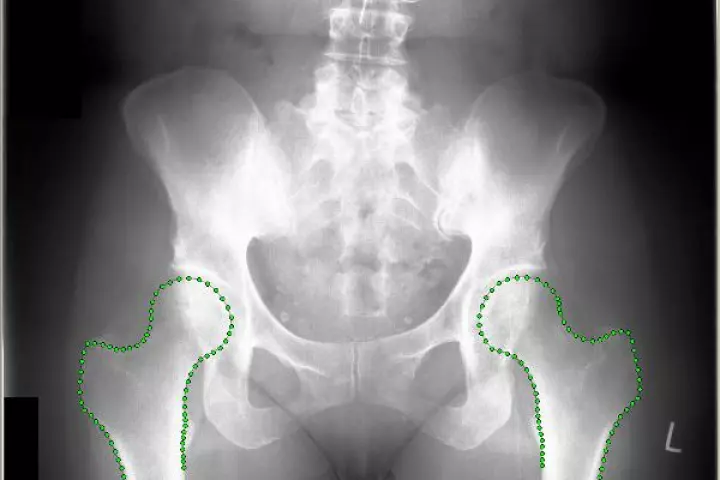 An x-ray displaying BoneFinder-enhanced hip bones