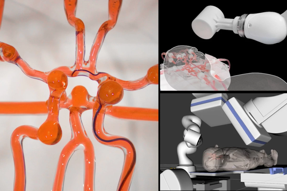 The telerobotic system (right, top and bottom) has been successfully used to guide a clot-busting wire through a model of the brain's blood vessels (left)