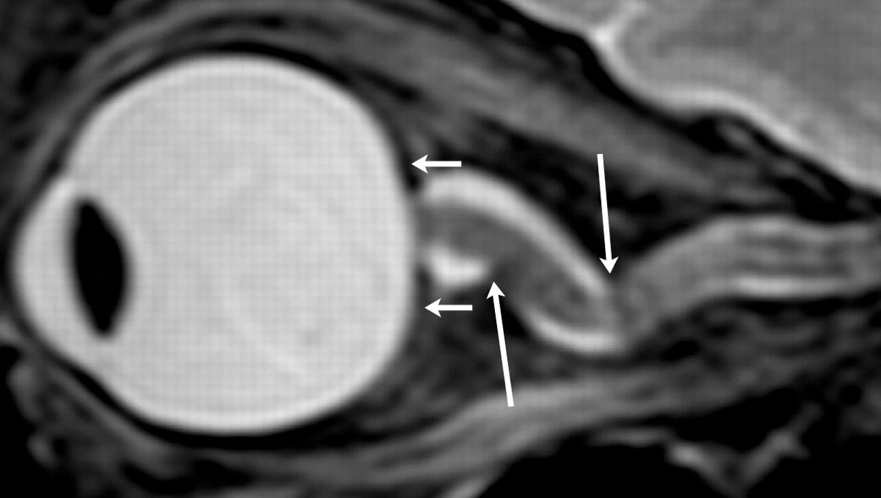MR image showing changes in eye structure after long-duration spaceflight