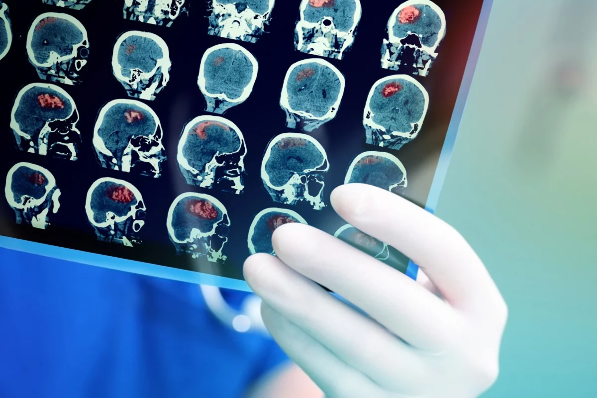 Researchers have discovered gadolinium, a chemical regularly given to patients for MRI scans, is accumulating in the eyes and may provide increase understanding of strokes