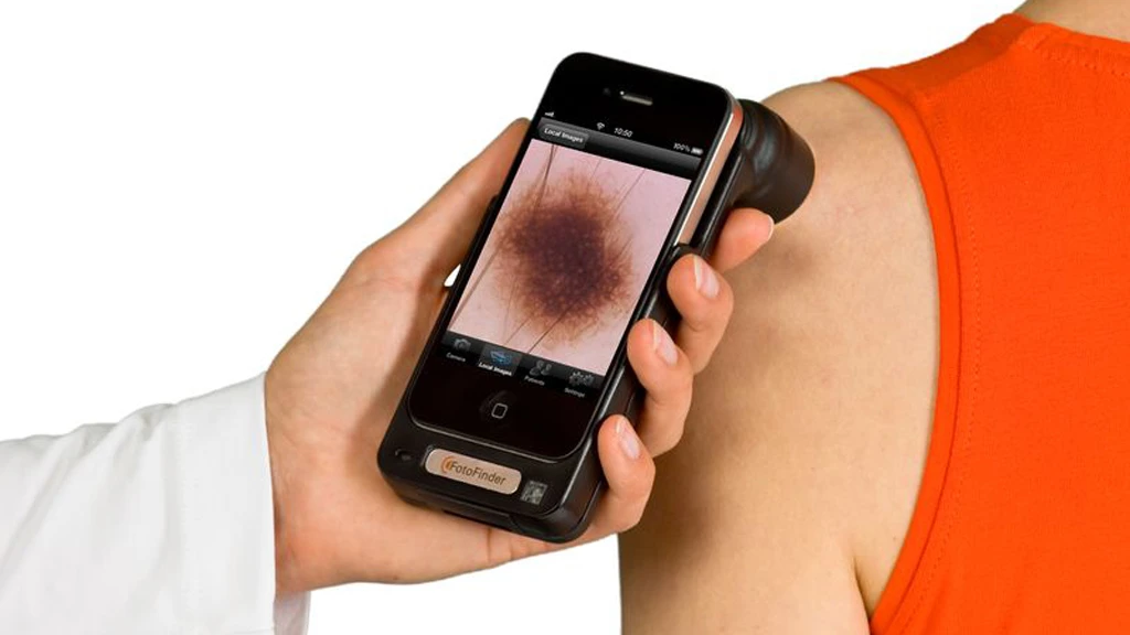 The handyscope digital dermascope accessory for iPhone