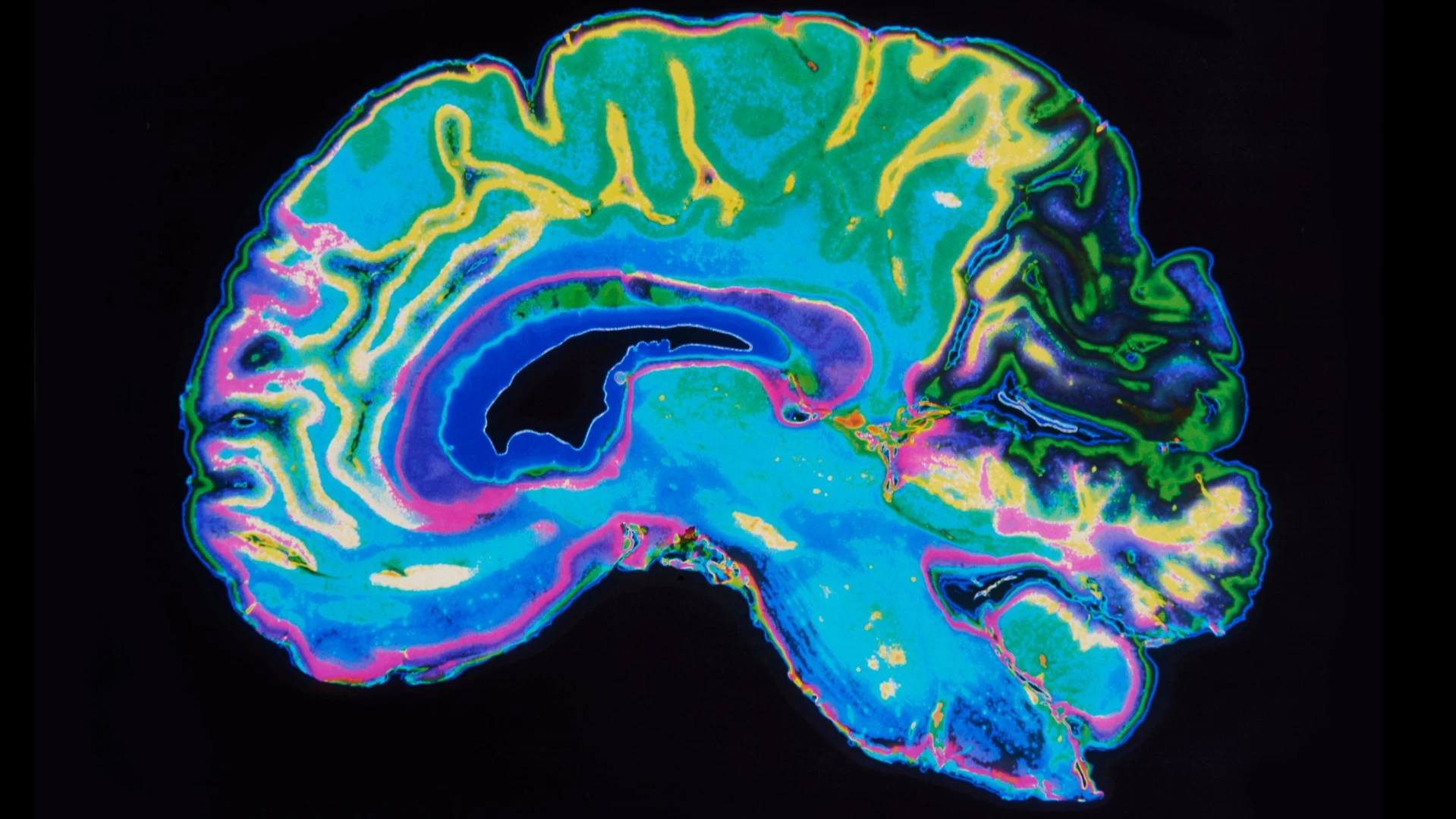 A new study suggests a simple brain scan could identify whether a person is having suicidal thoughts