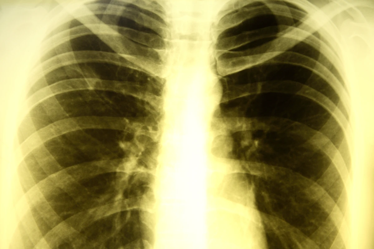 A team of international researchers has turned to stem cells in a quest to find an a more effective treatment for patients with resistant tuberculosis (Image: Shutterstock)