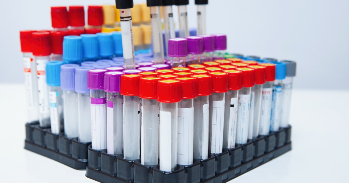 Prostate Cancer Blood Test Promises Paradigm Shift Prostate Cancer Blood Test Promises Paradigm Shift