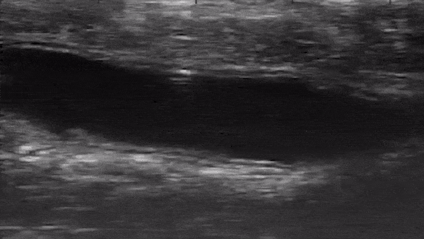 Video of a magnetic microbot tumbling through the colon