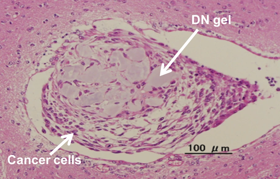 Stem cells cultured in the newly created hydrogel form a tumor when injected into a mouse brain