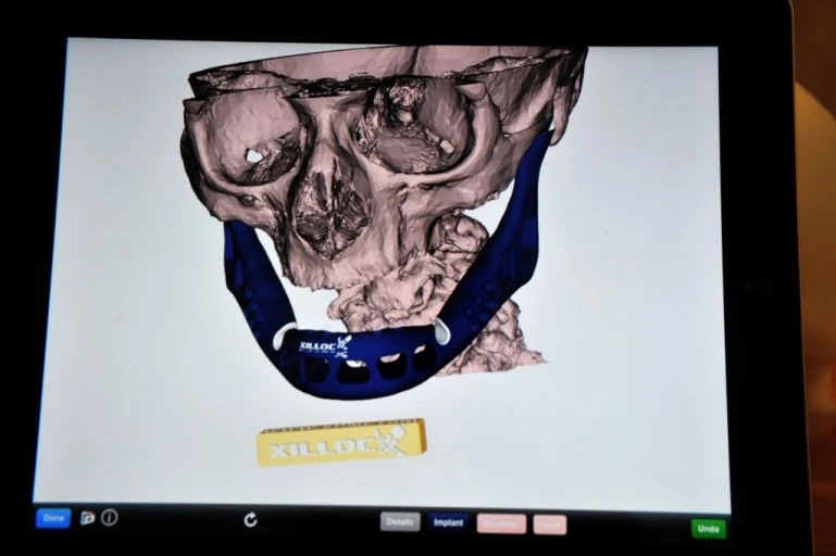 3D printing allows for a custom, snug fit