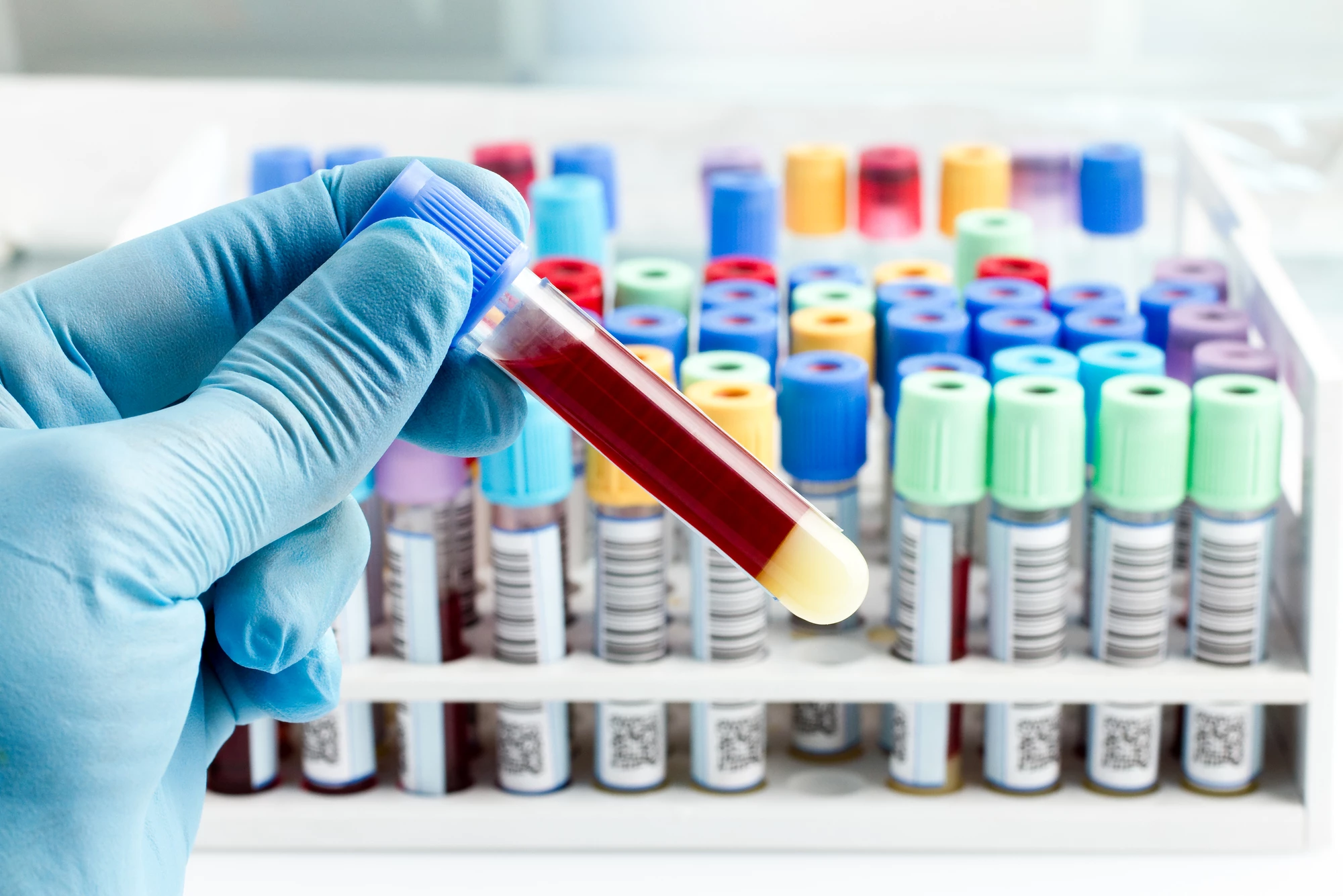 The new tests being developed for prostate cancer are still at least five years away from clinical use