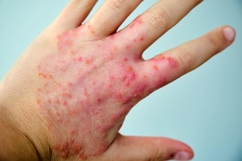 New Eczema Therapy Shows Promising Relief In Phase 2 Clinical Trials ?url=https%3A%2F%2Fnewatlas Brightspot.s3.amazonaws.com%2Fd8%2Fd8%2F87dbe72c4635a9d78f89ee4c13a1%2Fdepositphotos 693344772 L