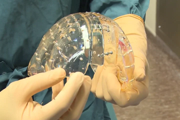 A woman's skull has been successfully replaced with a 3D-printed implant