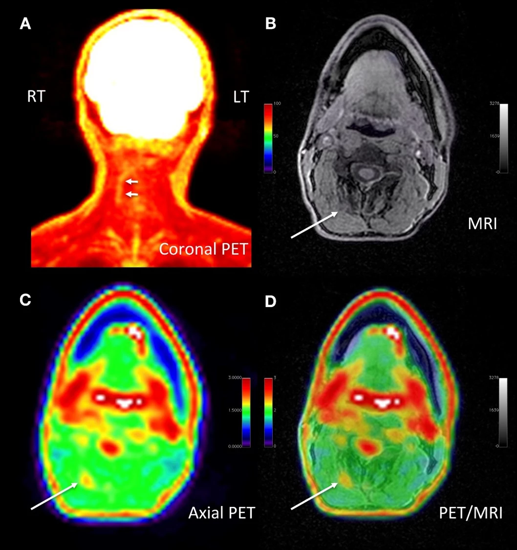 White arrows highlight the specific source of a man's chronic neck pain