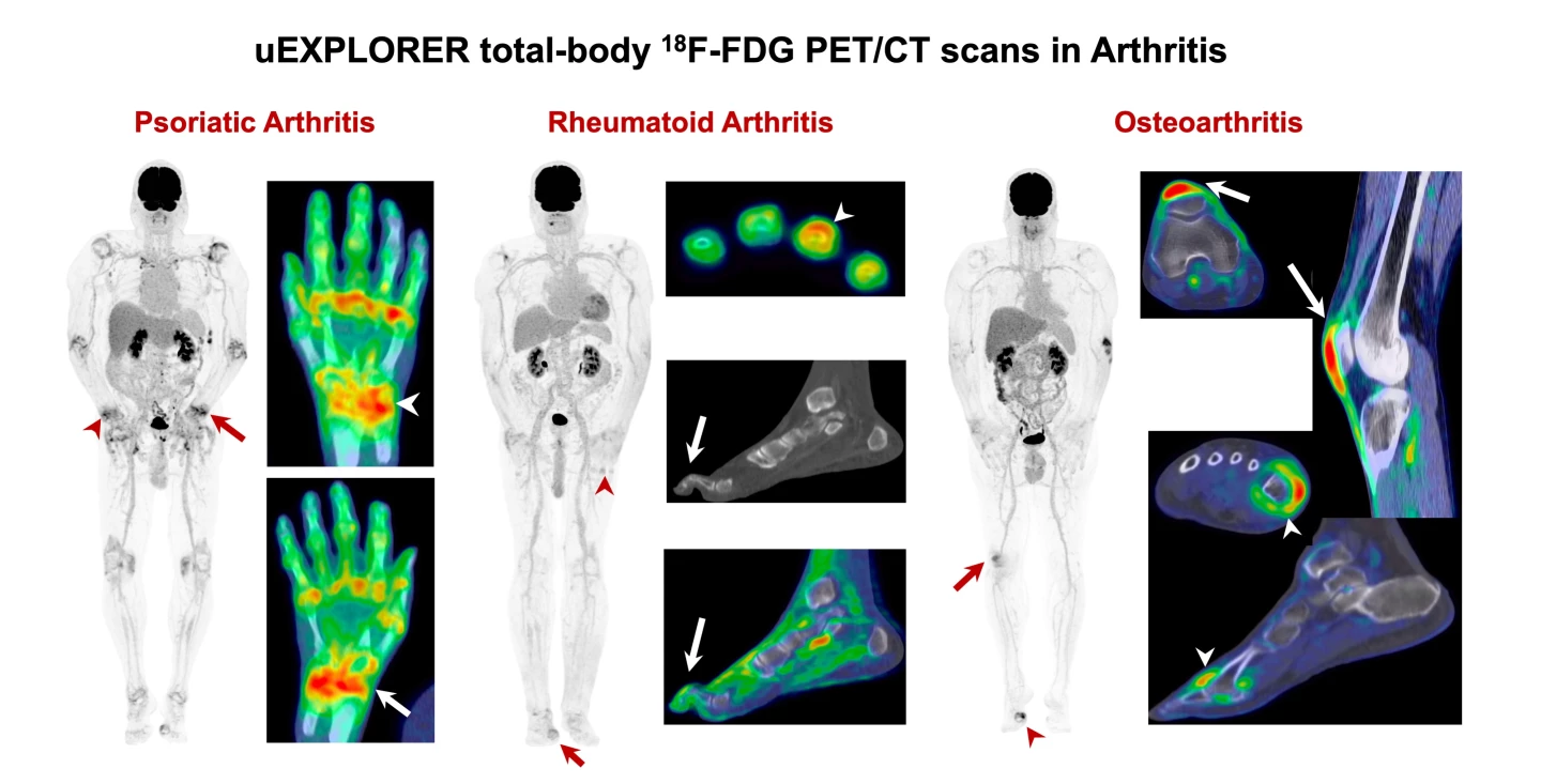 Full-body scans highlight the different systemic inflammatory patterns associated with three kinds of arthritis