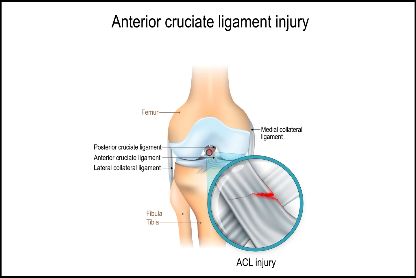 Anterior cruciate ligament injury