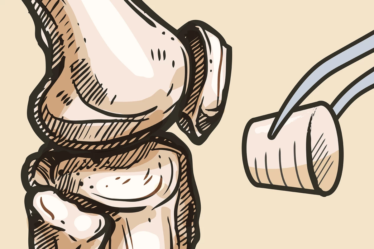 Synthetic 'plugs' heal damagedcartilage and bone and may replace total knee replacements