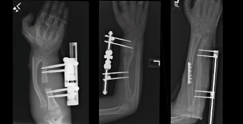 X-ray images of various distraction osteogenesis rigs in place