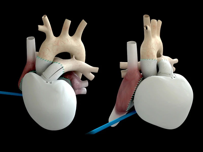 Renderings of an implanted Carmat artificial heart