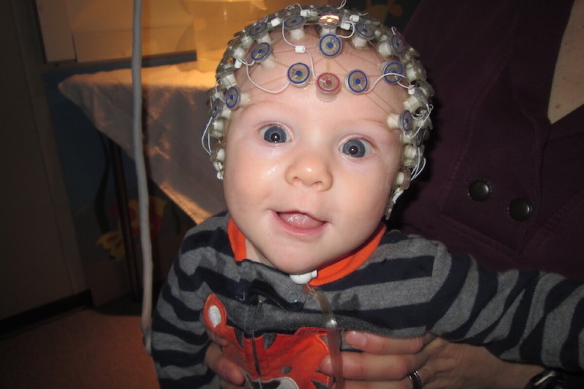 A simple EEG could accurately predict the onset of ASD as early as three months of age