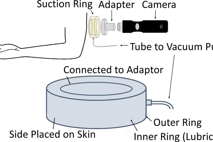 A schematic of Binghamton University's scar-minimizing device