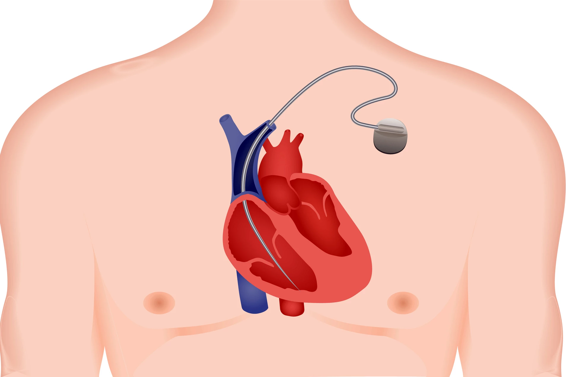 An automatic implantable cardioverter defibrillator (AICD) shocks abnormal heart rhythms