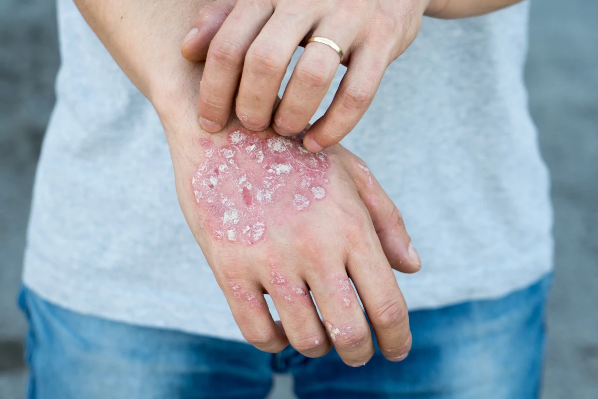 Researchers have found a way of modulating the immune system to treat autoimmune skin diseases like psoriasis