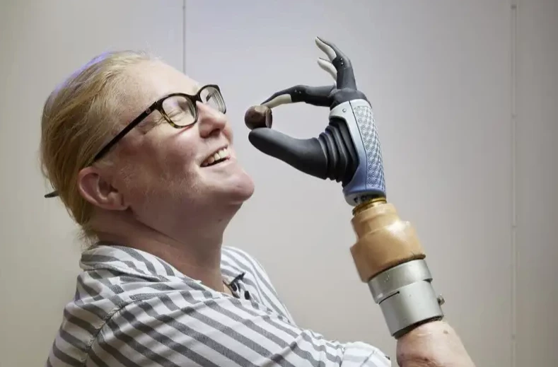 Karin demonstrates the dexterity of her Mia Hand bionic hand