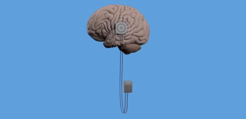 The Johns Hopkins software is designed to work with systems like this, in which implanted electrodes deliver electrical pulses to a targeted location of the brain