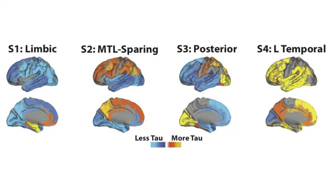 The four different patterns of tau spread detected in the new study