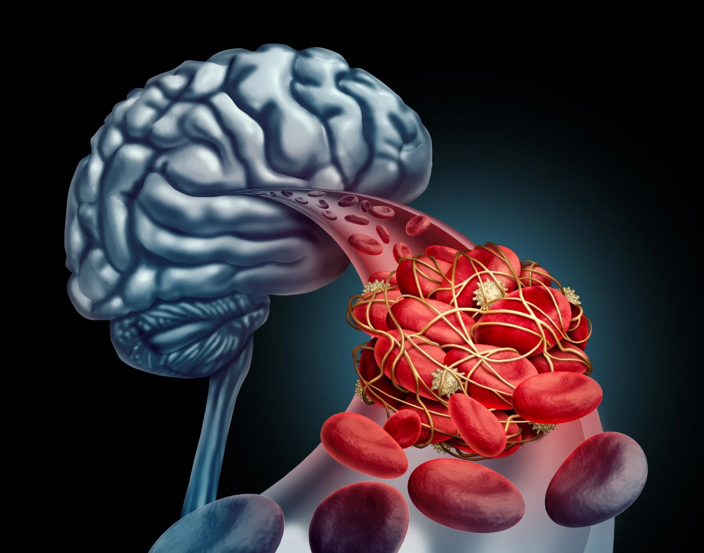 Scientists believe they have uncovered a major reason for blockages in blood flow that can affect cognitive function in Alzheimer’s sufferers