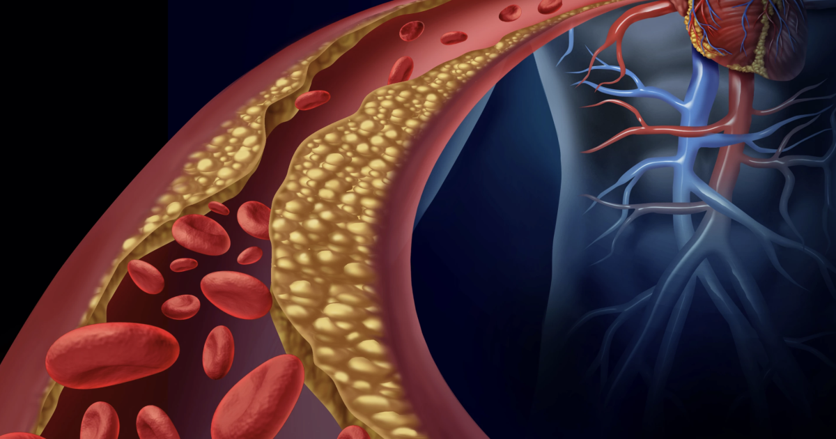 Nanoparticles detect and reduce artery plaques Nanoparticles detect and reduce artery plaques