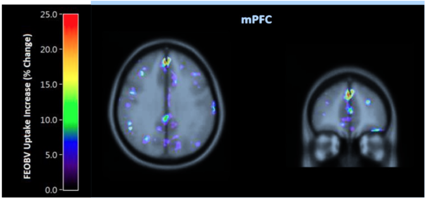 Post six weeks of brain training, increases in acetylcholine were seen in the brain. This image is of the left and right medial prefrontal cortex