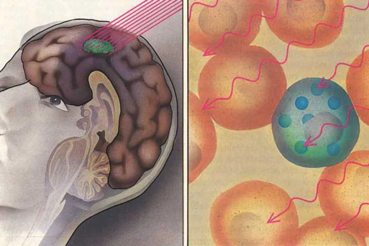 Boron neutron capture therapy can kill tumors without harming healthy neighboring tissue