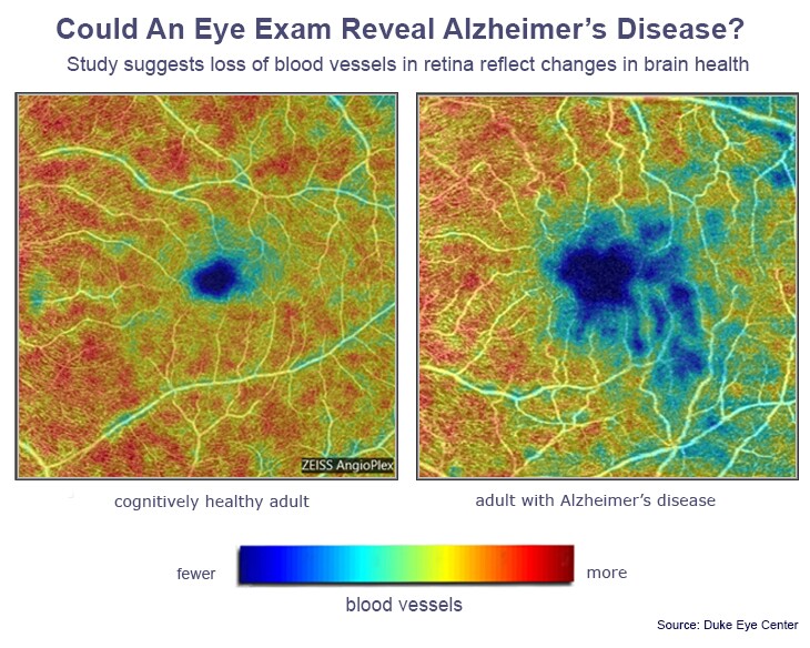 The differences in blood vessel density between Alzheimer's subjects and cognitively healthy subjects identified in the new scan