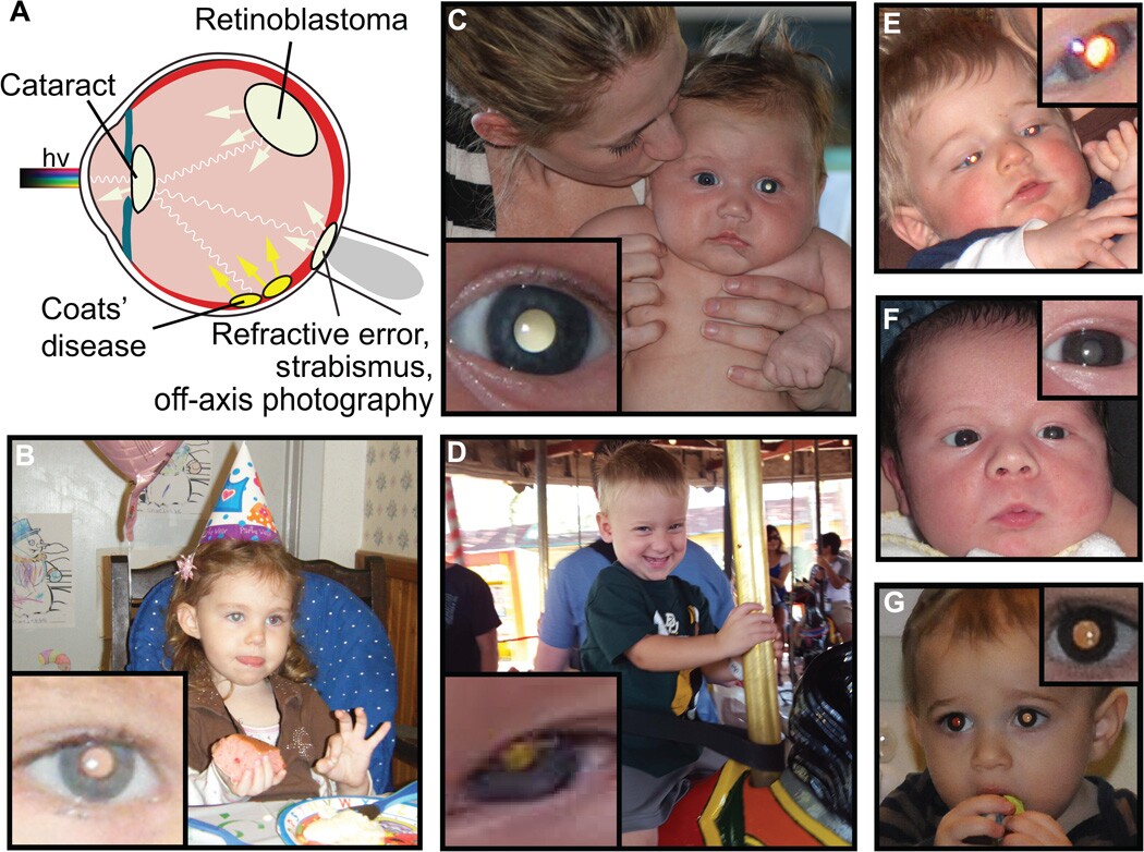 Examples of pathologic and physiologic leukocoria detected in childhood photographs by the prototype CRADLE application