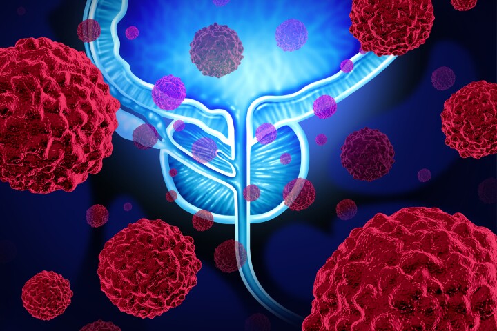 Researchers have identified the gene responsible for causing prostate cancer to metastasize