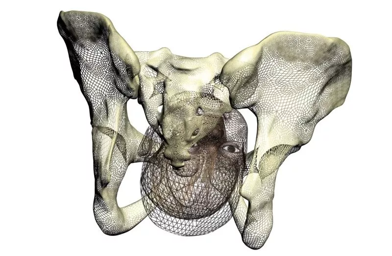A PREDIBIRTH simulation displays the way in which a baby's head may pass through its mother's birth canal