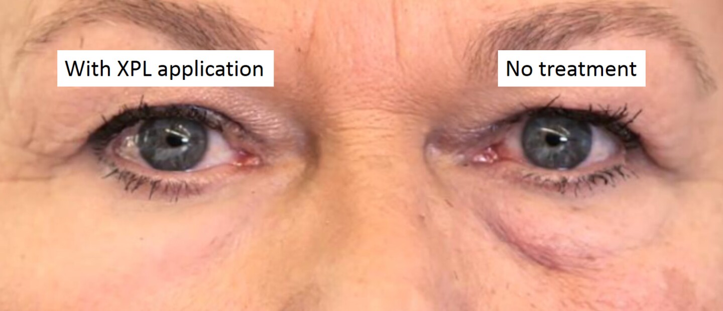 In testing, the researchers applied the XPL to the bags under a subject's eyes