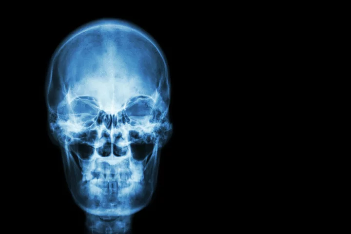 The successful isolation of stem cells for skull and face bones could lead to new treatments for dangerous conditions
