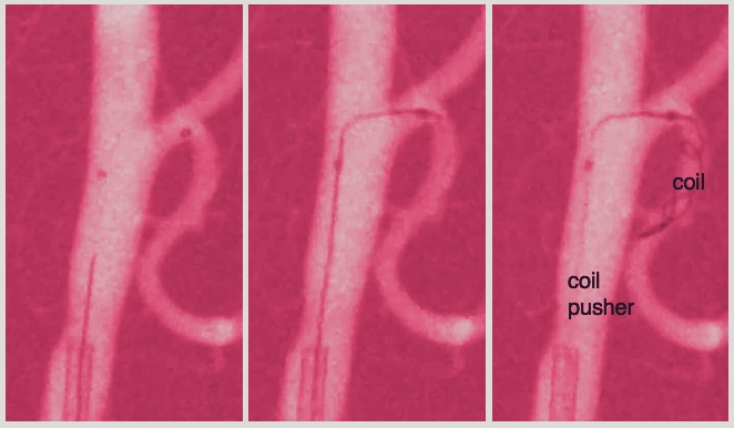 Scientists demonstrated their steerable catheter in the brains of pigs