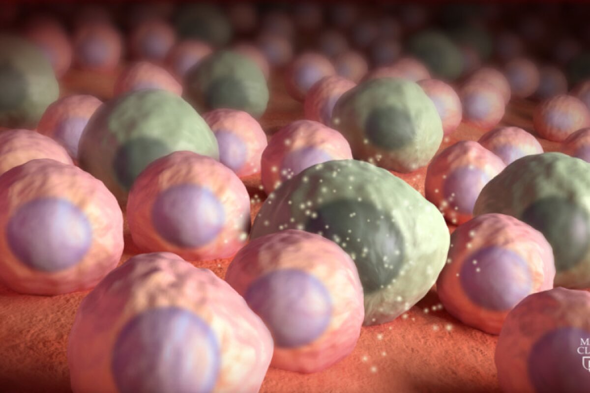 Clearing out brain's "zombie cells" offers new approach against dementia