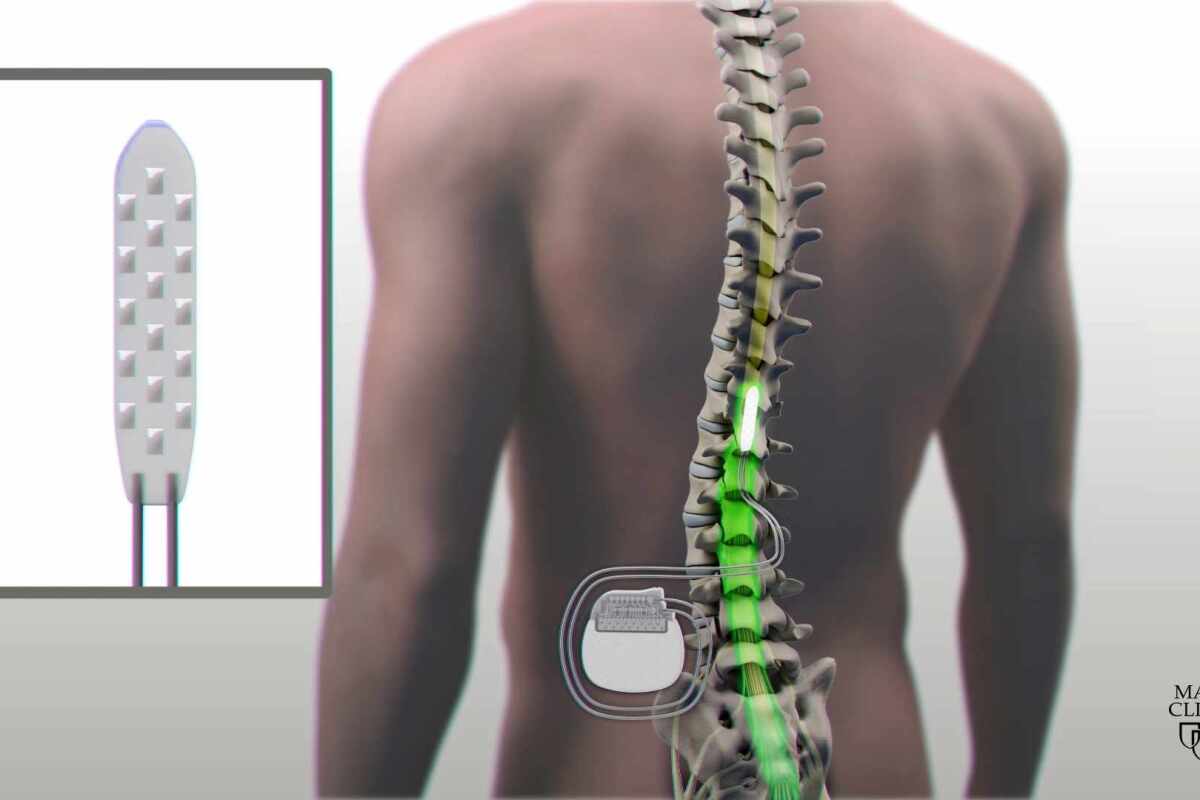 Electric spinal stimulation helps paraplegic man regain control of legs