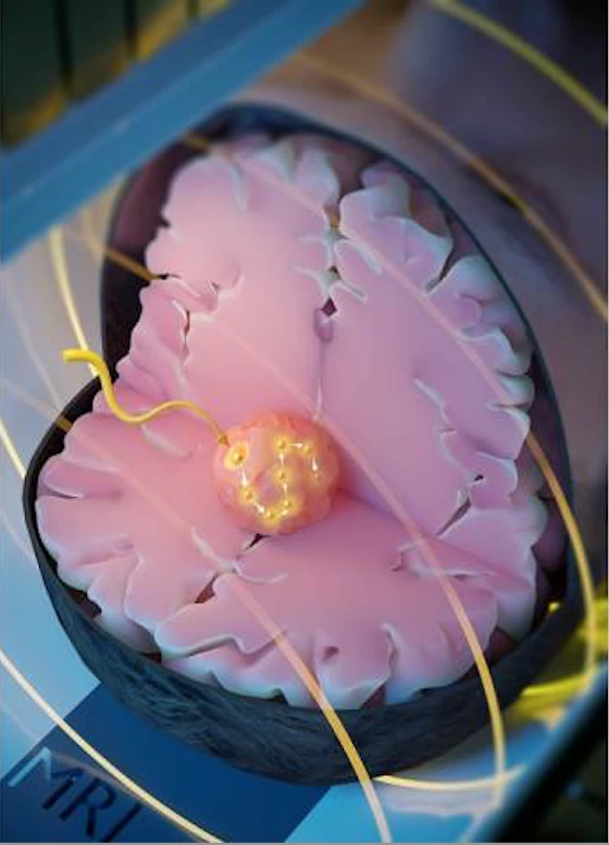 Artist's impression of a newly developed magnetic seed at the tumor site